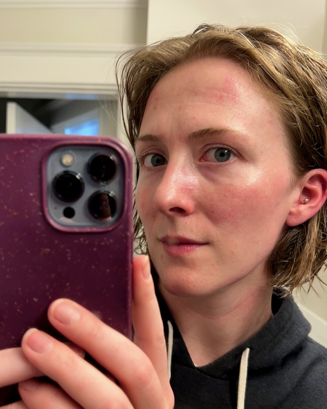 My skin after learning how to dermaplane at home (using a plastic-free dermaplaning tool): minor redness that went away quickly, revealing smooth, exfoliated skin. ©KettiWilhelm2023